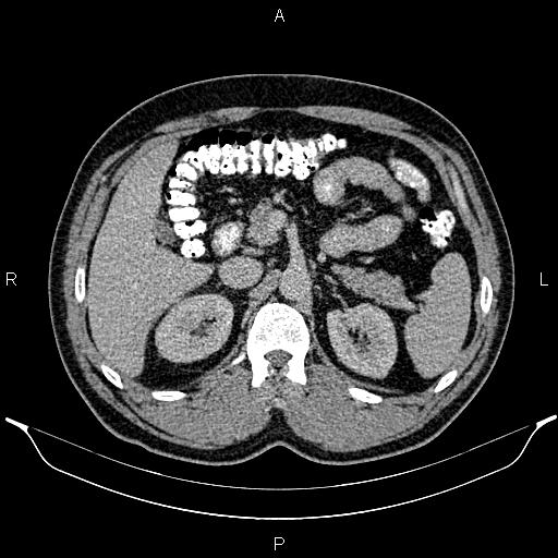 Acute appendicitis (Radiopaedia 84780-100240 Axial C+ portal venous phase 35).jpg
