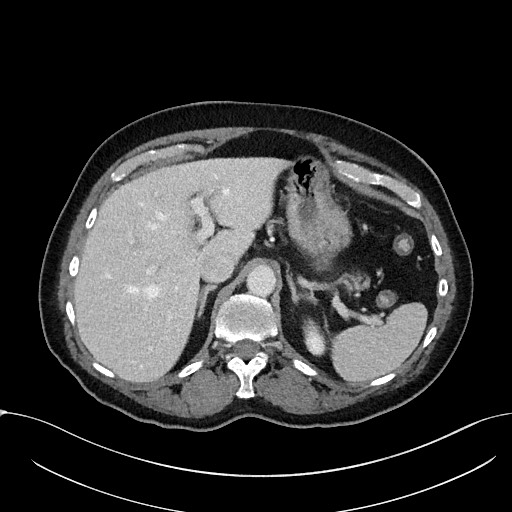 Acute appendicitis - large appendicoliths (Radiopaedia 61805-69820 Axial C+ portal venous phase 29).jpg
