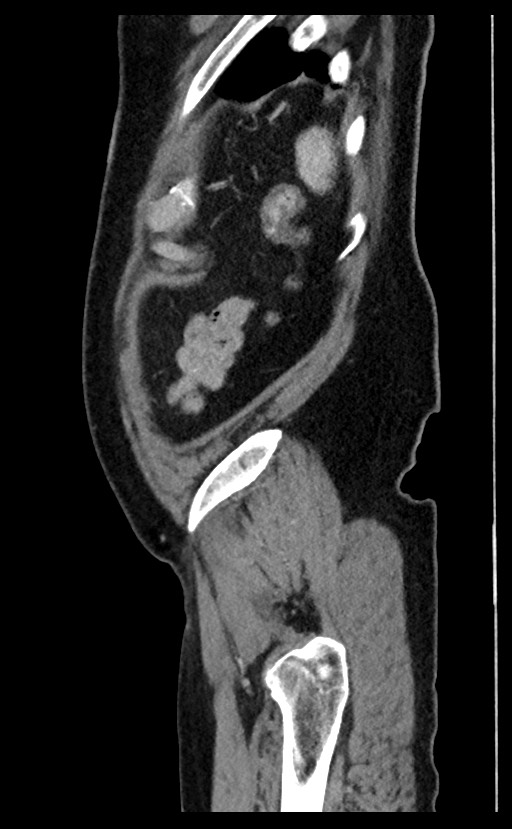 Acute appendicitis - large appendicoliths (Radiopaedia 61805-69820 Sagittal C+ portal venous phase 11).jpg