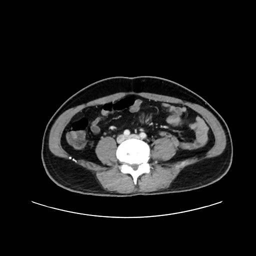 Acute appendicitis and COVID 19 pneumonia (Radiopaedia 76604-88380 Axial C+ portal venous phase 52).jpg