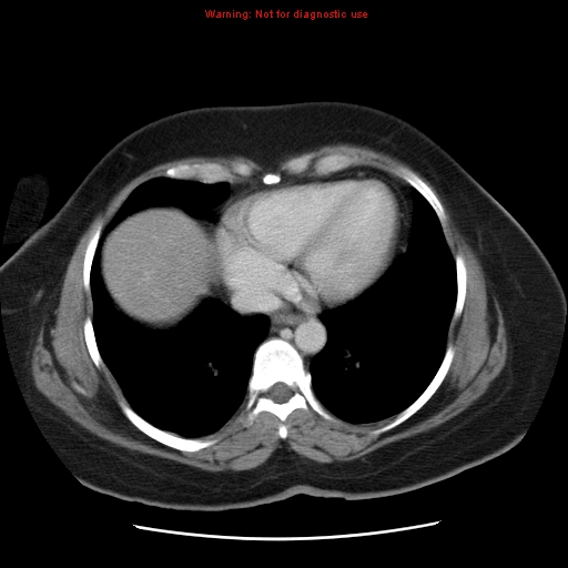 File:Acute appendicitis complicated by ovarian vein thrombophlebitis (Radiopaedia 16172-15851 Axial C+ portal venous phase 12).jpg