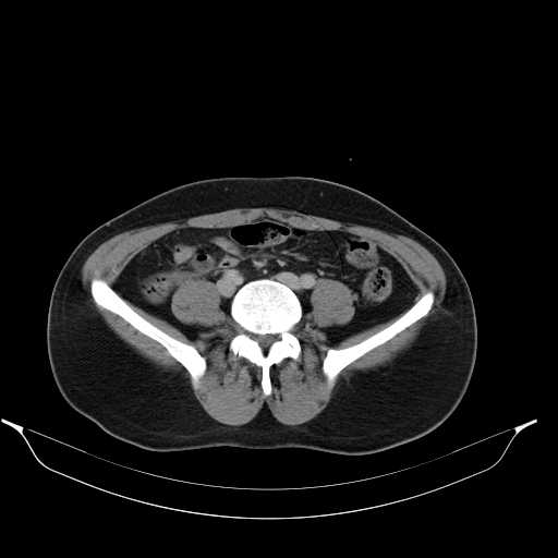 File:Acute appendicitis with appendicoliths (Radiopaedia 21148-21062 Axial C+ portal venous phase 10).jpg