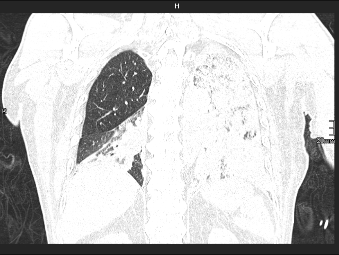 File:Acute aspiration pneumonitis (Radiopaedia 55642-62166 Coronal lung window 75).jpg
