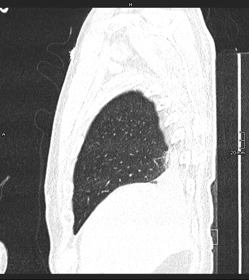 Acute aspiration pneumonitis (Radiopaedia 55642-62166 Sagittal lung window 135).jpg