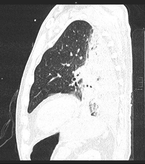 Acute aspiration pneumonitis (Radiopaedia 55642-62166 Sagittal lung window 38).jpg