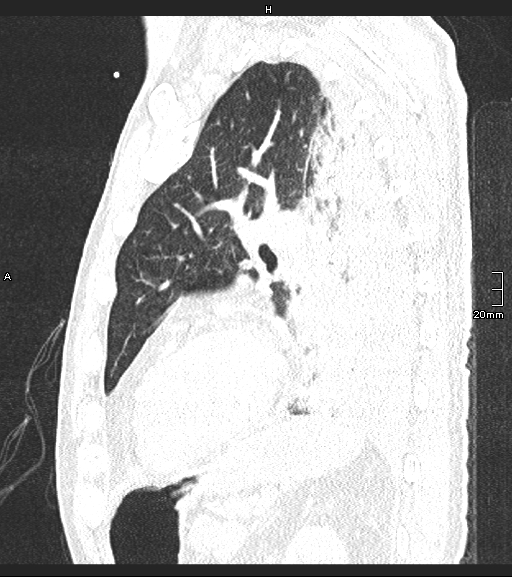 Acute aspiration pneumonitis (Radiopaedia 55642-62166 Sagittal lung window 46).jpg