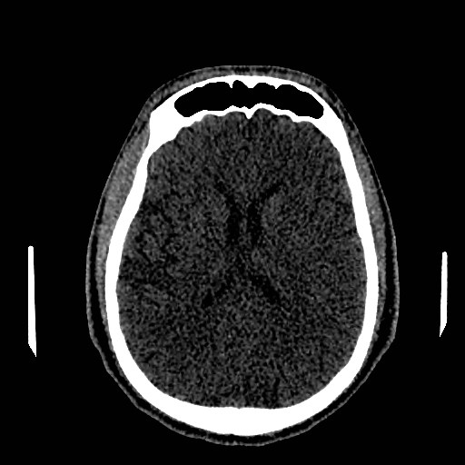 Acute basilar artery occlusion (Radiopaedia 43582-46985 Axial non-contrast 106).jpg