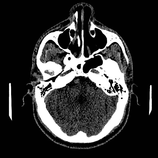 Acute basilar artery occlusion (Radiopaedia 43582-46985 Axial non-contrast 56).jpg