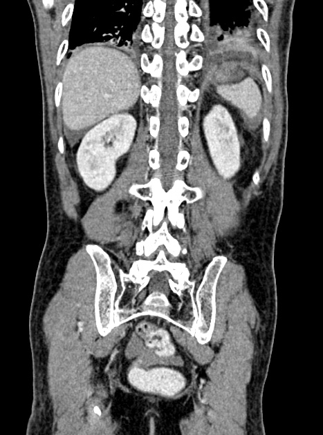 Acute bowel ischemia (Radiopaedia 87695-104114 Coronal C+ portal venous phase 294).jpg