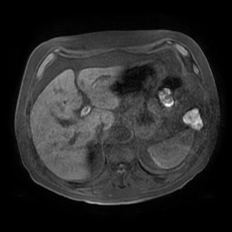 Acute cholecystitis complicated by pylephlebitis (Radiopaedia 65782-74915 Axial T1 fat sat 34).jpg