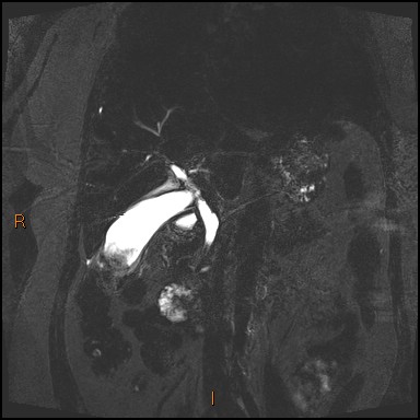 File:Acute cholecystitis with gallbladder neck calculus (Radiopaedia 42795-45971 Coronal Turbo spin echo 22).jpg
