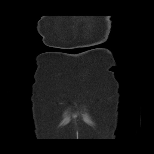 File:Acute cholecystitis with tensile fundus sign (Radiopaedia 71394-81723 Coronal non-contrast 121).jpg