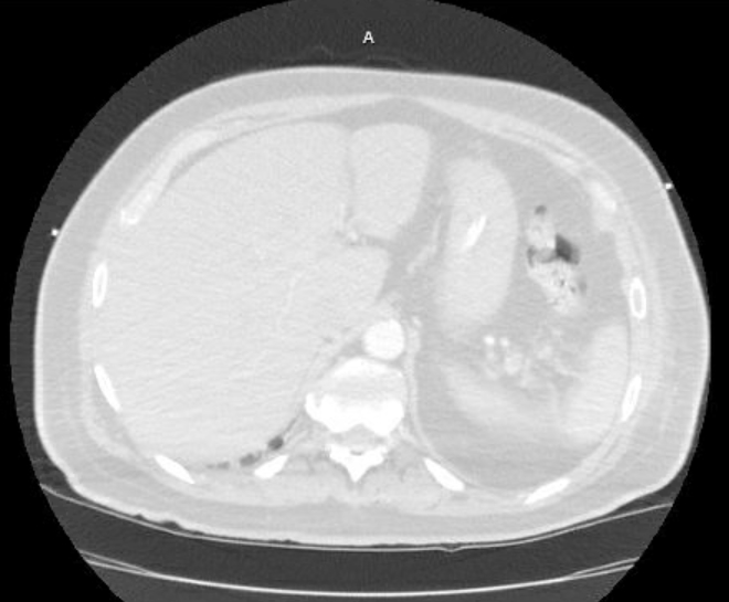 Acute cor pulmonale (ultrasound) (Radiopaedia 83508-98818 Axial lung window 89).jpg