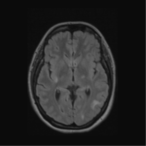 Acute disseminated encephalomyelitis (ADEM) (Radiopaedia 38073-40065 Axial FLAIR 30).png