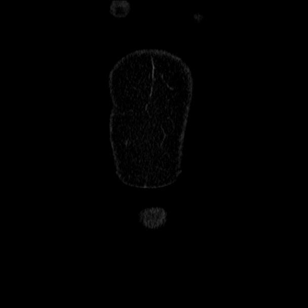 Acute diverticulitis (Radiopaedia 34183-35442 Coronal C+ portal venous phase 2).jpg