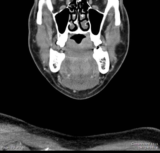 Acute epiglottitis (Radiopaedia 54375-60590 Coronal C+ arterial phase 23).jpg