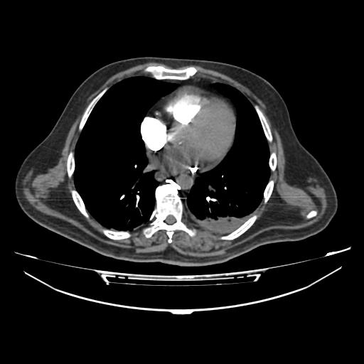 Acute heart failure (CT) (Radiopaedia 79835-93075 Axial C+ arterial phase 27).jpg