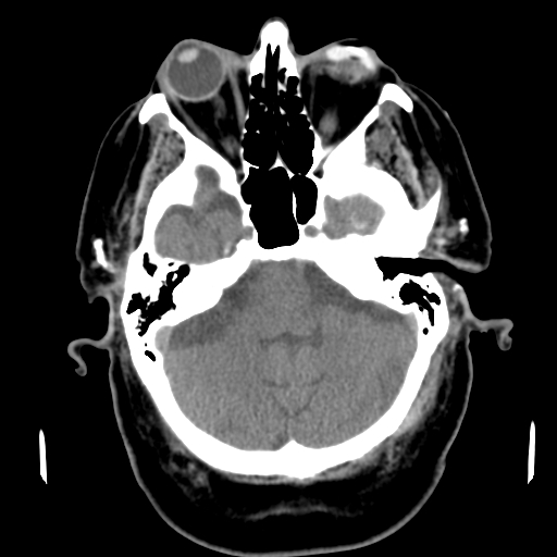 File:Acute hemorrhagic stroke (Radiopaedia 17507-17223 Axial non-contrast 13).jpg
