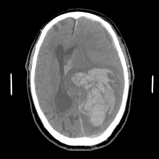 File:Acute hemorrhagic stroke (Radiopaedia 17507-17223 Axial non-contrast 30).jpg