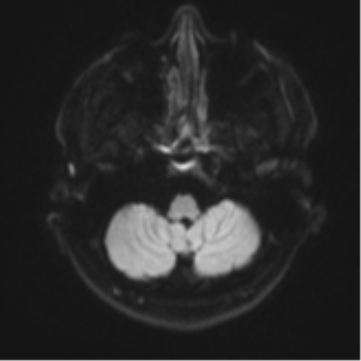 Acute left middle cerebral artery territory infarct with clot retrieval (Radiopaedia 47732-52433 Axial DWI 35).png