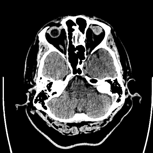 Acute left middle cerebral artery territory ischemic stroke (Radiopaedia 35688-37223 Axial non-contrast 15).png