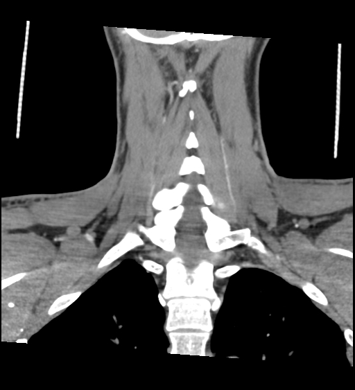 Acute longus colli calcific tendinitis (Radiopaedia 72495-83036 Coronal C+ arterial phase 53).jpg