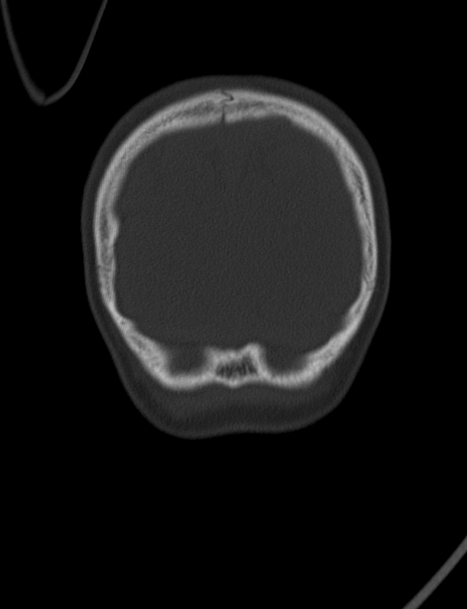 Acute mastoiditis (Radiopaedia 82678-96881 Coronal bone window 74).jpg