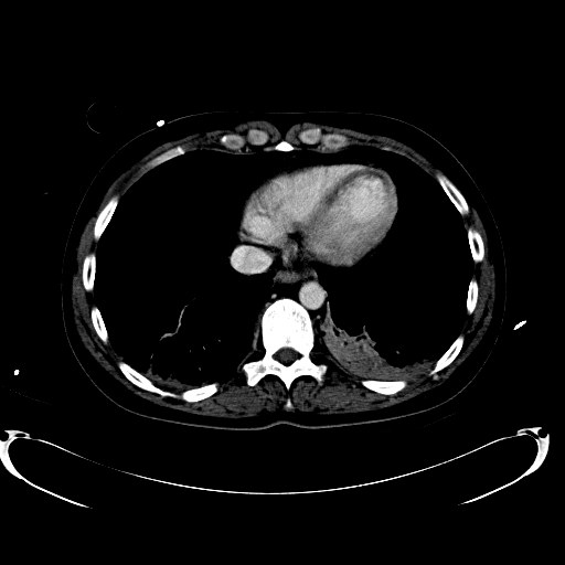 File:Acute myocardial infarction in CT (Radiopaedia 39947-42457 Axial C+ portal venous phase 11).jpg
