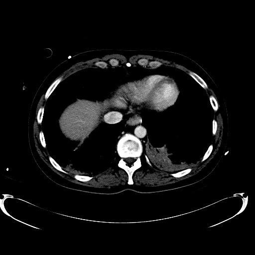 File:Acute myocardial infarction in CT (Radiopaedia 39947-42457 Axial C+ portal venous phase 14).jpg
