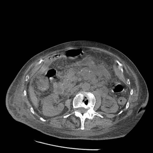 Acute on chronic pancreatitis (Radiopaedia 13233-13244 Axial non-contrast 44).jpg
