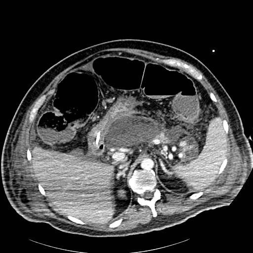 Acute pancreatic necrosis (Radiopaedia 13560-18502 Axial C+ portal venous phase 18).jpg
