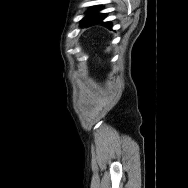 Acute pancreatitis (Radiopaedia 26663-26813 Sagittal C+ portal venous phase 70).jpg