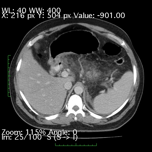 File:Acute pancreatitis (Radiopaedia 34043-35276 Axial C+ portal venous phase 25).jpg