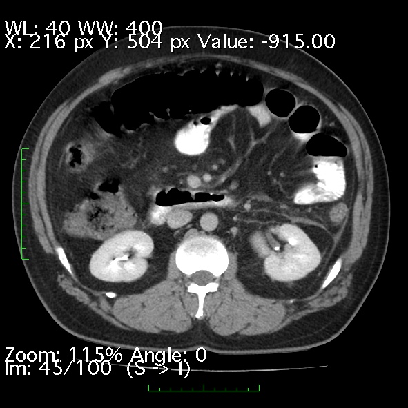 Acute pancreatitis (Radiopaedia 34043-35276 Axial C+ portal venous phase 45).jpg