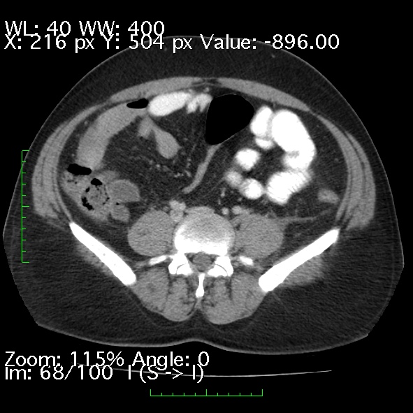 Acute pancreatitis (Radiopaedia 34043-35276 Axial C+ portal venous phase 68).jpg