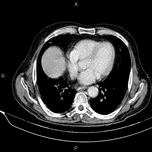 Acute pancreatitis (Radiopaedia 85146-100701 Axial C+ portal venous phase 9).jpg