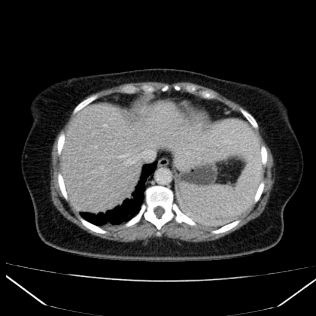 Acute pancreatitis - Balthazar C (Radiopaedia 26569-26714 Axial C+ portal venous phase 21).jpg
