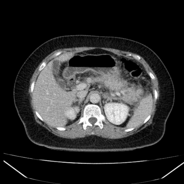 Acute pancreatitis - Balthazar C (Radiopaedia 26569-26714 Axial C+ portal venous phase 34).jpg