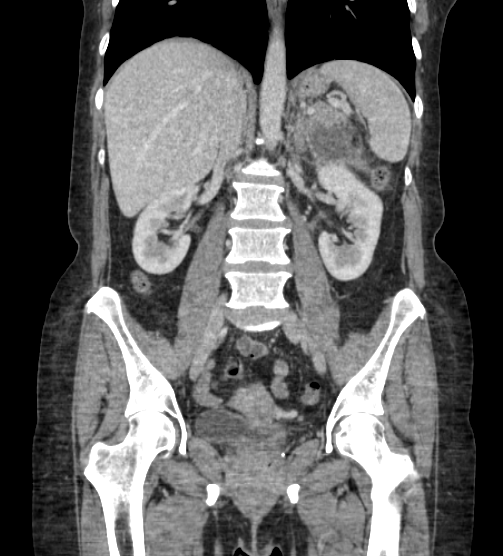 Acute pancreatitis - Balthazar E - post ERCP (Radiopaedia 27562-27772 Coronal C+ portal venous phase 49).png