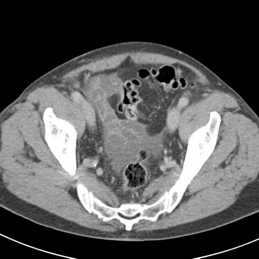 Acute pancreatitis and walled-off necrosis (Radiopaedia 29888-30403 Axial C+ delayed 72).jpg