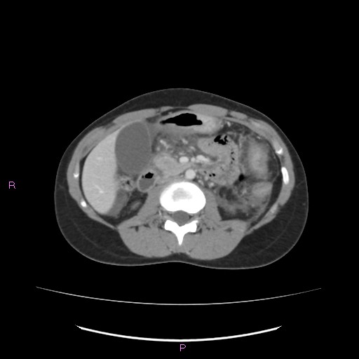 Acute pancreatitis secondary to stone at minor papilla and pancreatic divisum (Radiopaedia 76570-88333 Axial C+ portal venous phase 35).jpg