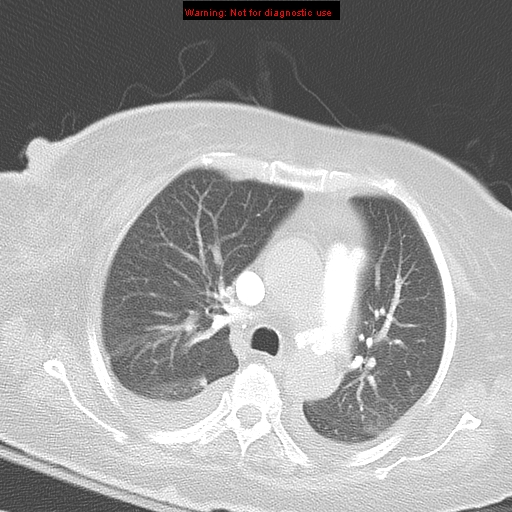 File:Acute pulmonary embolism (Radiopaedia 13286-13289 B 16).jpg