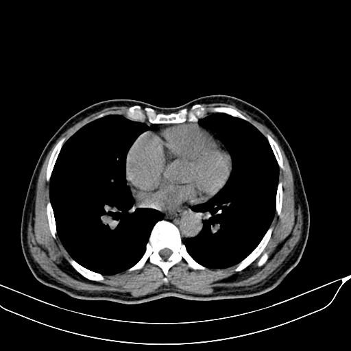 File:Acute pulmonary embolism (Radiopaedia 69510-79390 Axial non-contrast 39).jpg