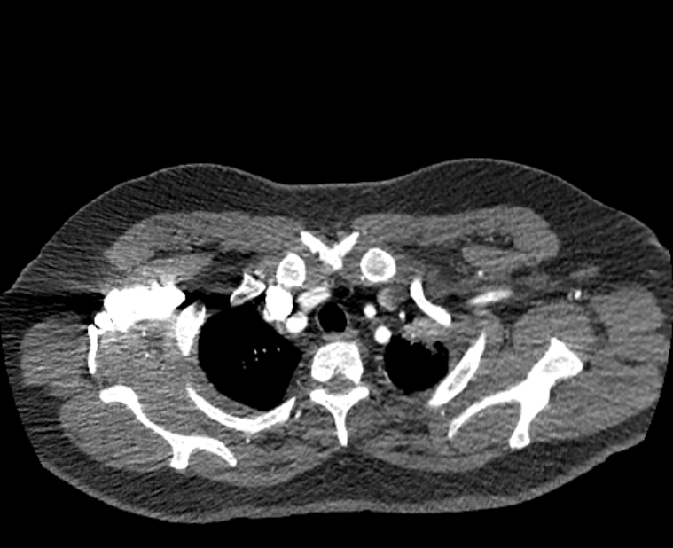 Acute pulmonary embolism with pulmonary infarcts (Radiopaedia 77688-89908 Axial C+ CTPA 4).jpg