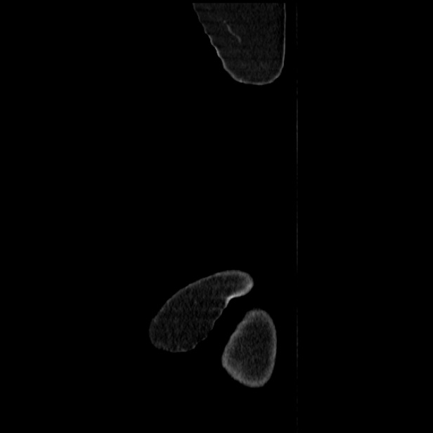 Acute pyelonephritis (Radiopaedia 25657-25837 Sagittal renal parenchymal phase 1).jpg