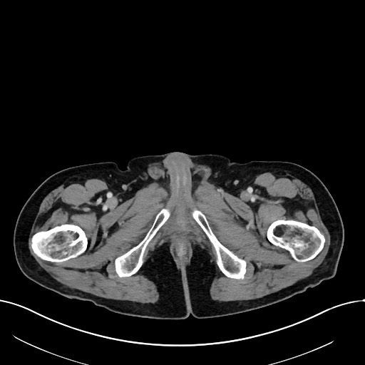Acute renal infarction (Radiopaedia 59375-66736 Axial C+ portal venous phase 130).jpg