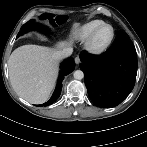 Acute renal infarction - rim capsular enhancement (Radiopaedia 59833-67270 Axial C+ portal venous phase 11).jpg