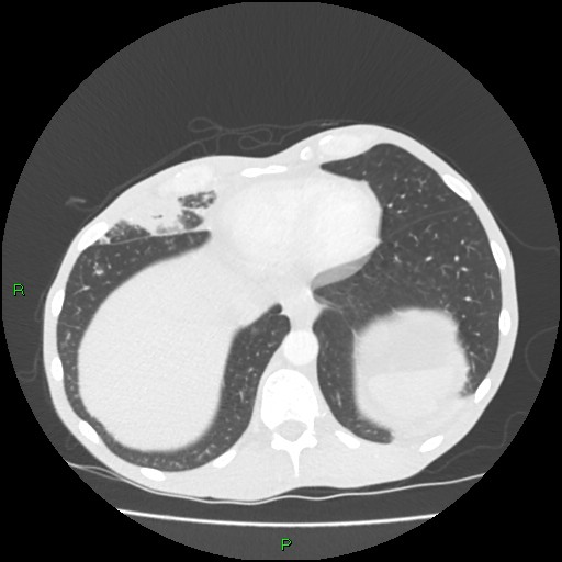 Acute right lung abscess (Radiopaedia 34806-36258 Axial lung window 154).jpg