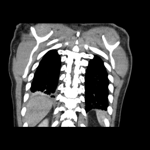 Acute segmental pulmonary emboli and pulmonary infarction (Radiopaedia 62264-70444 Coronal C+ CTPA 49).jpg