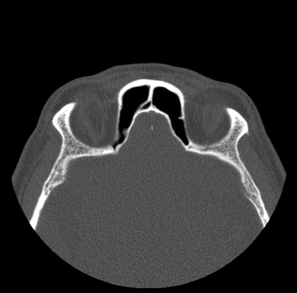 Acute sinusitis (Radiopaedia 23161-23215 Axial bone window 61).jpg